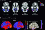 بررسی کینتیک enhancment توده های تخمدانی توسط dynamic contrast-enhanced magnetic resonance imaging  ((DCE-MRIو مقایسه با یافته ای سونوگرافی ساده و کالر داپلر